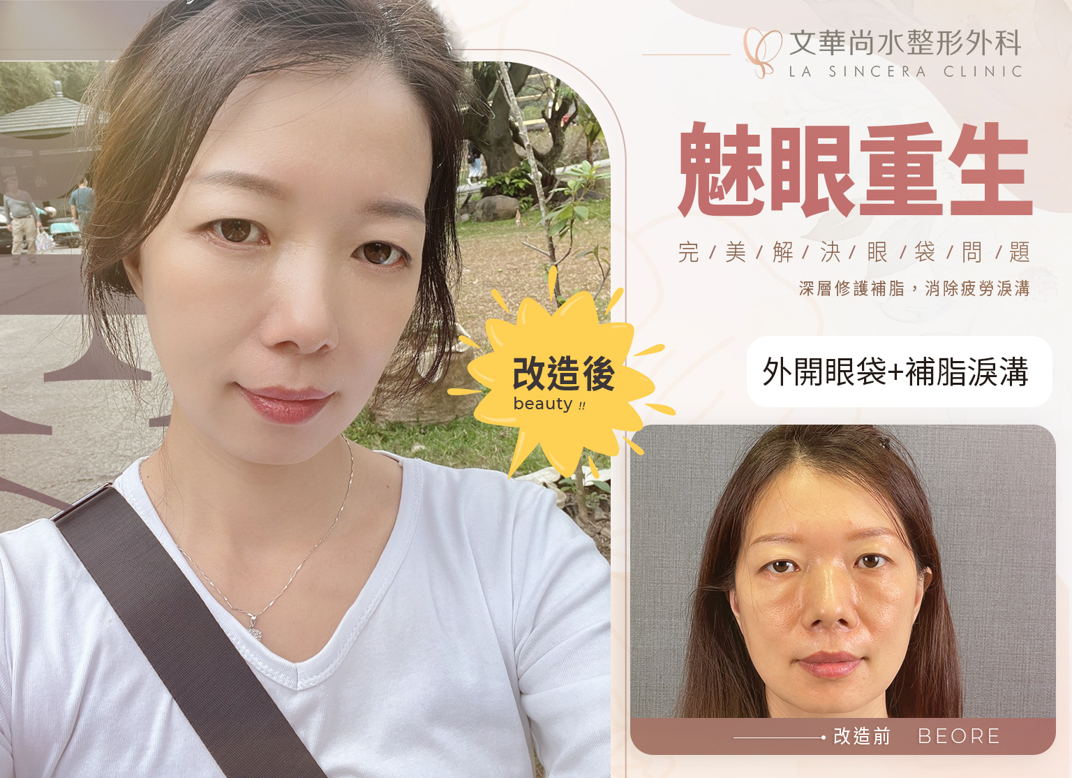 大膽展現:外開眼袋與補脂淚溝的魅力轉變