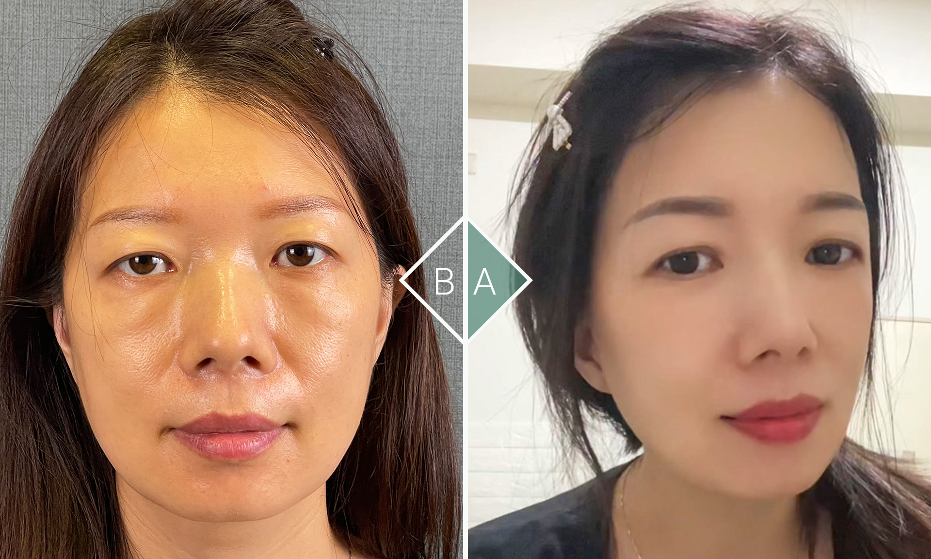 美麗的蜕變:如何通過外開眼袋與補脂淚溝手術展現全新魅力