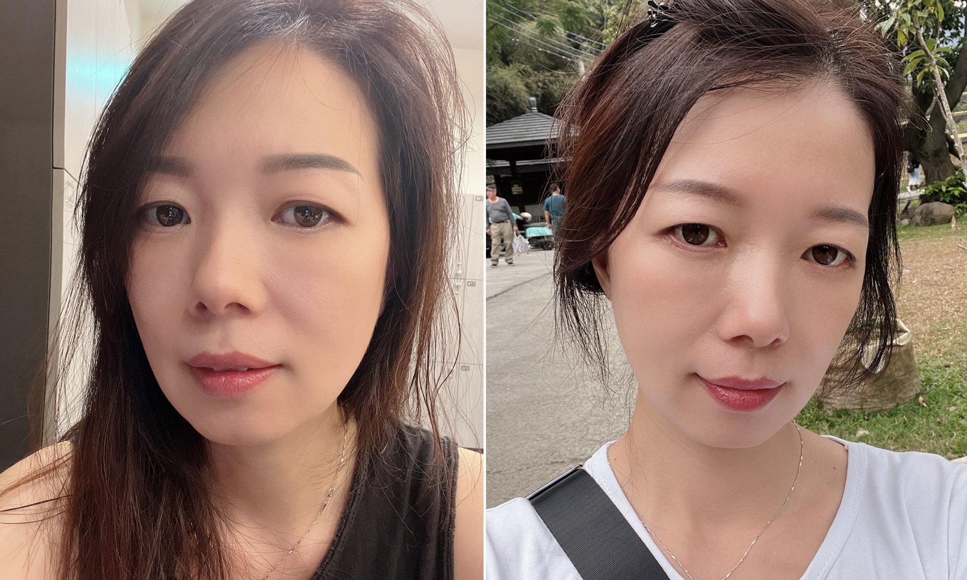 華麗雙眸的誕生：外開眼袋與補脂淚溝手術的藝術之旅