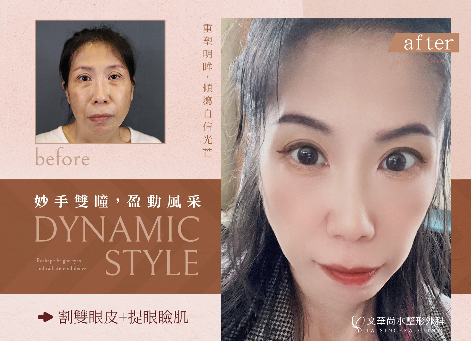 一刀雙變:割雙眼皮的美麗蛻變之旅