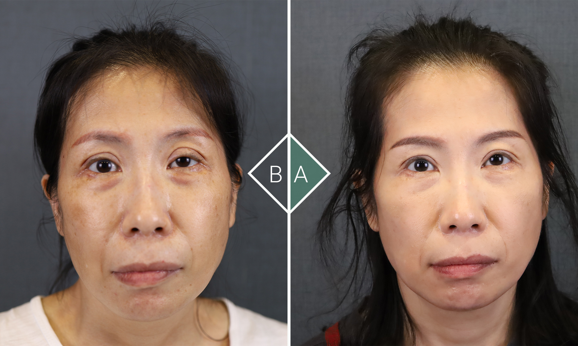 締造自然雙眼魅力:割雙眼皮的新趨勢